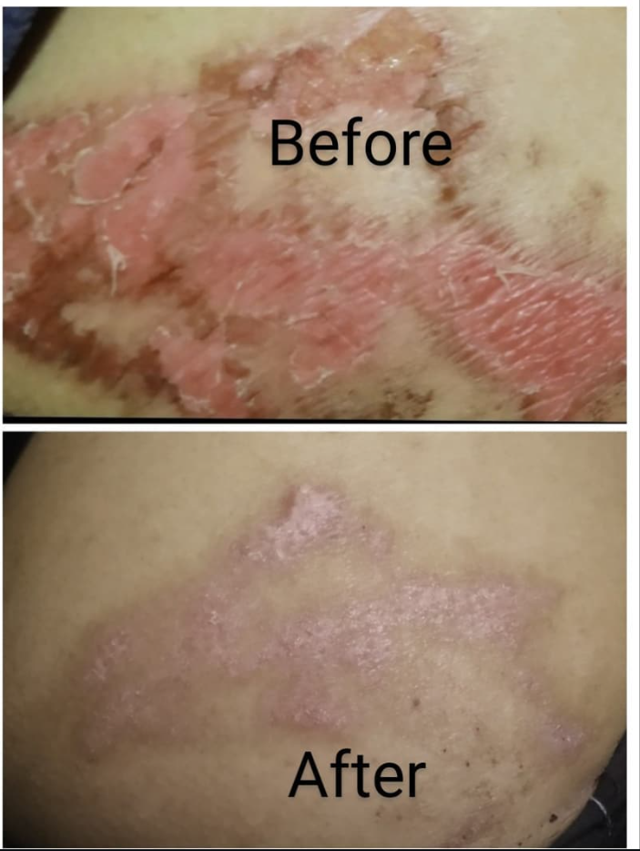 Chronic Psoriasis Recovery