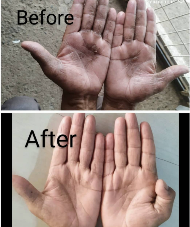 Palmar Eczema Healing