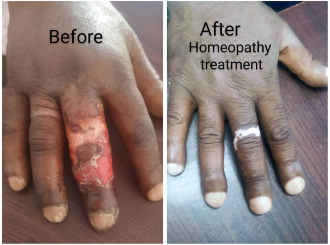 Infected Wound Recovery
