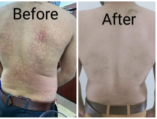 Back Eczema Treatment