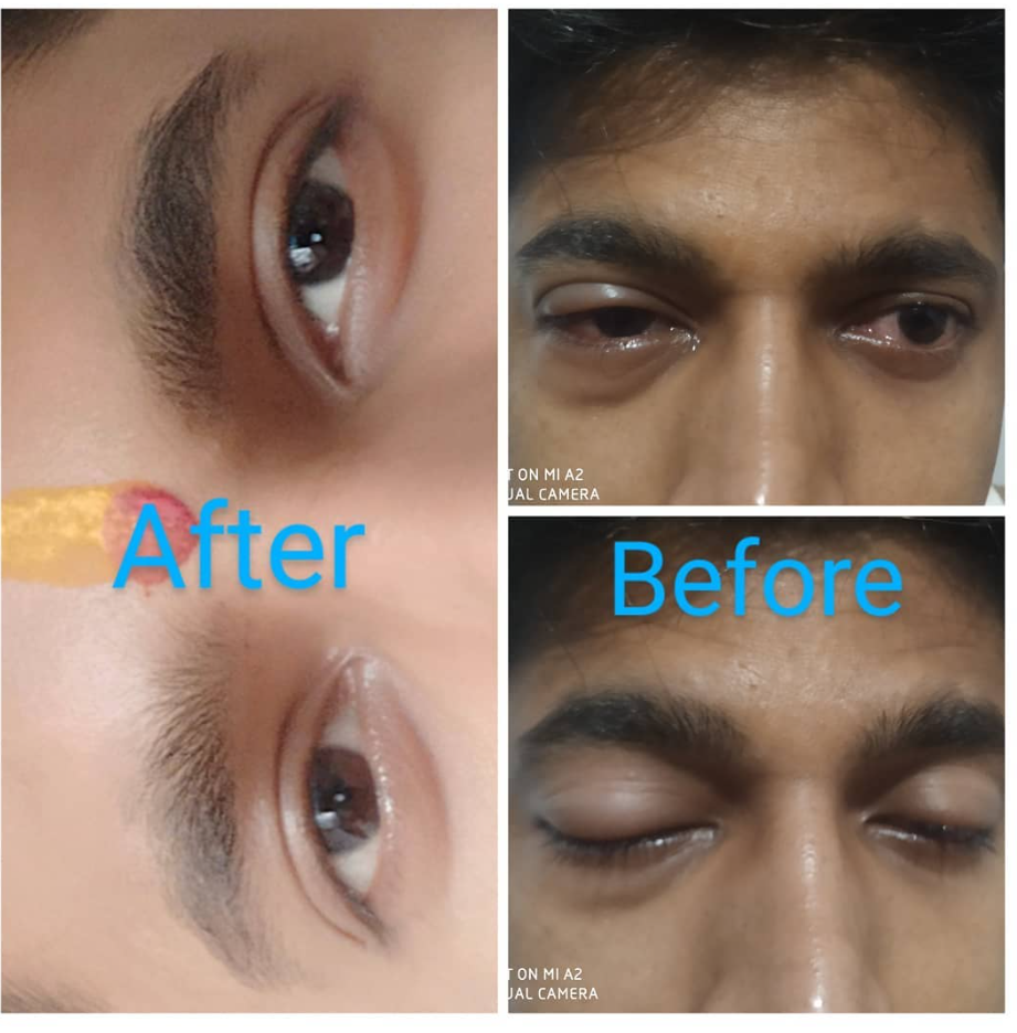 Allergic Conjunctivitis Treatment