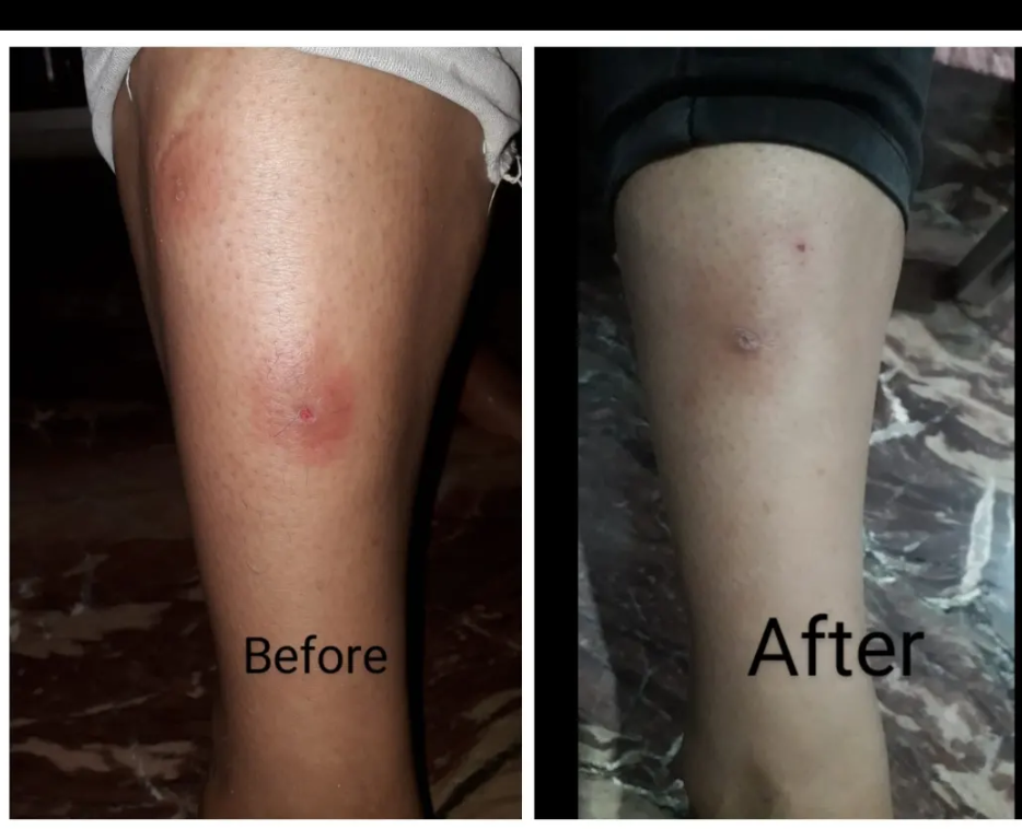 Fungal Infection Healing