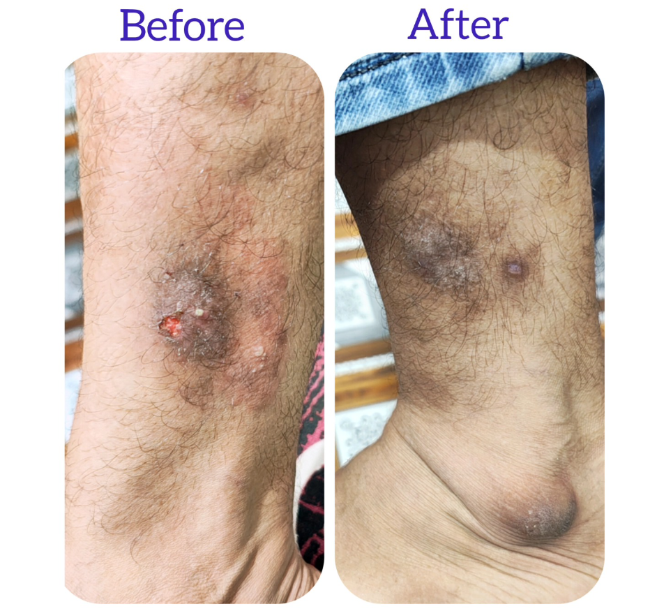 Chronic Wound Healing