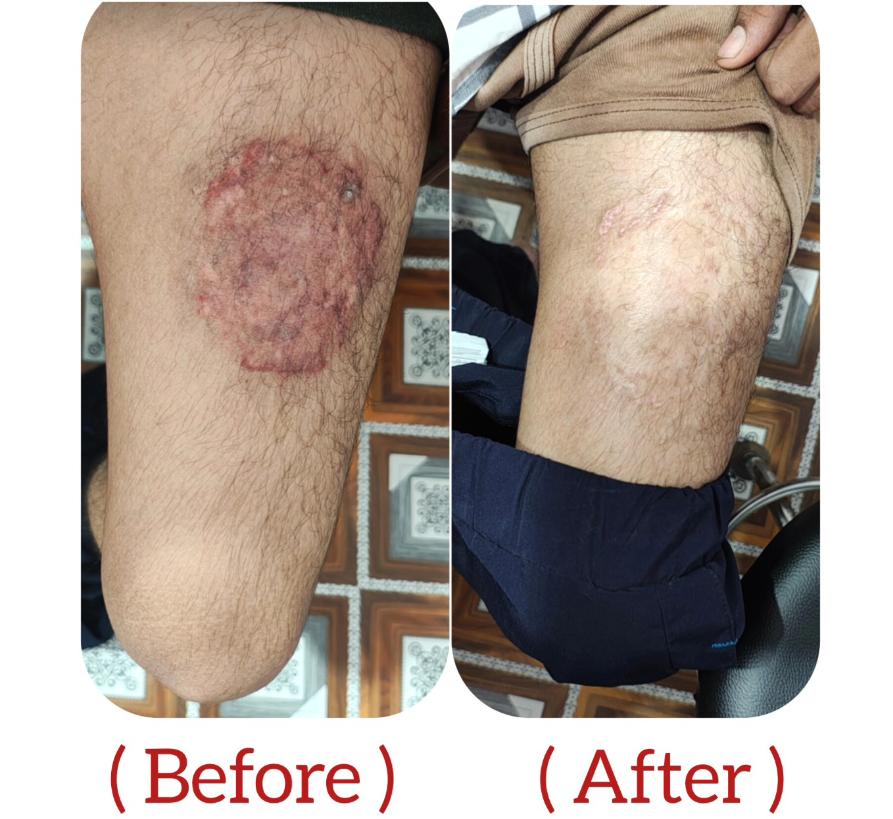 Ringworm Treatment Result